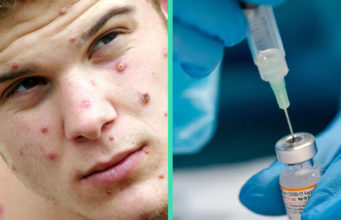 Anti-vaxxer hoping for monkeypox to arrive in Malta so he can stay relevant